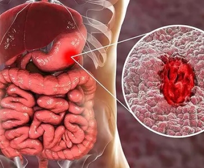 Ung thư dạ dày có nguy hiểm không?